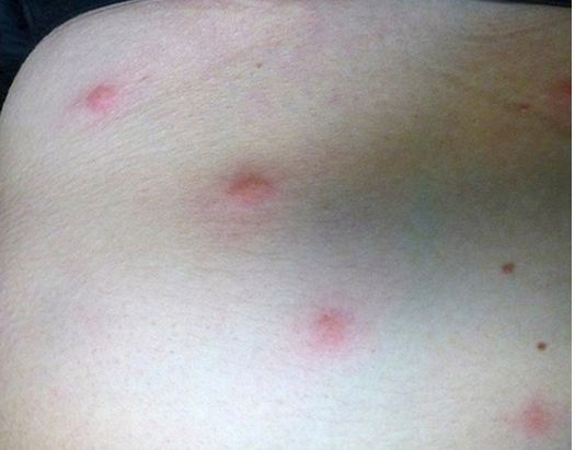 ... it was in a $3 room where I acquired these bites. Bedbugs, I assume